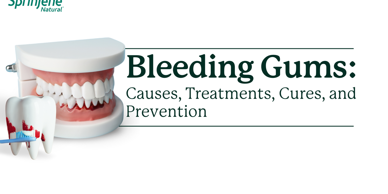 Bleeding Gums: Causes, Treatments, Cures, and Prevention