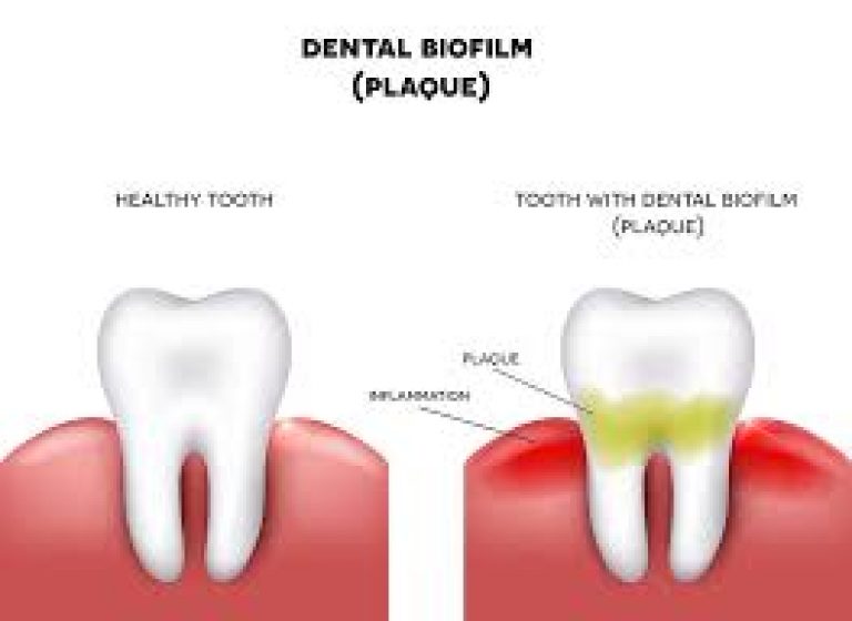 biofilm and teeth