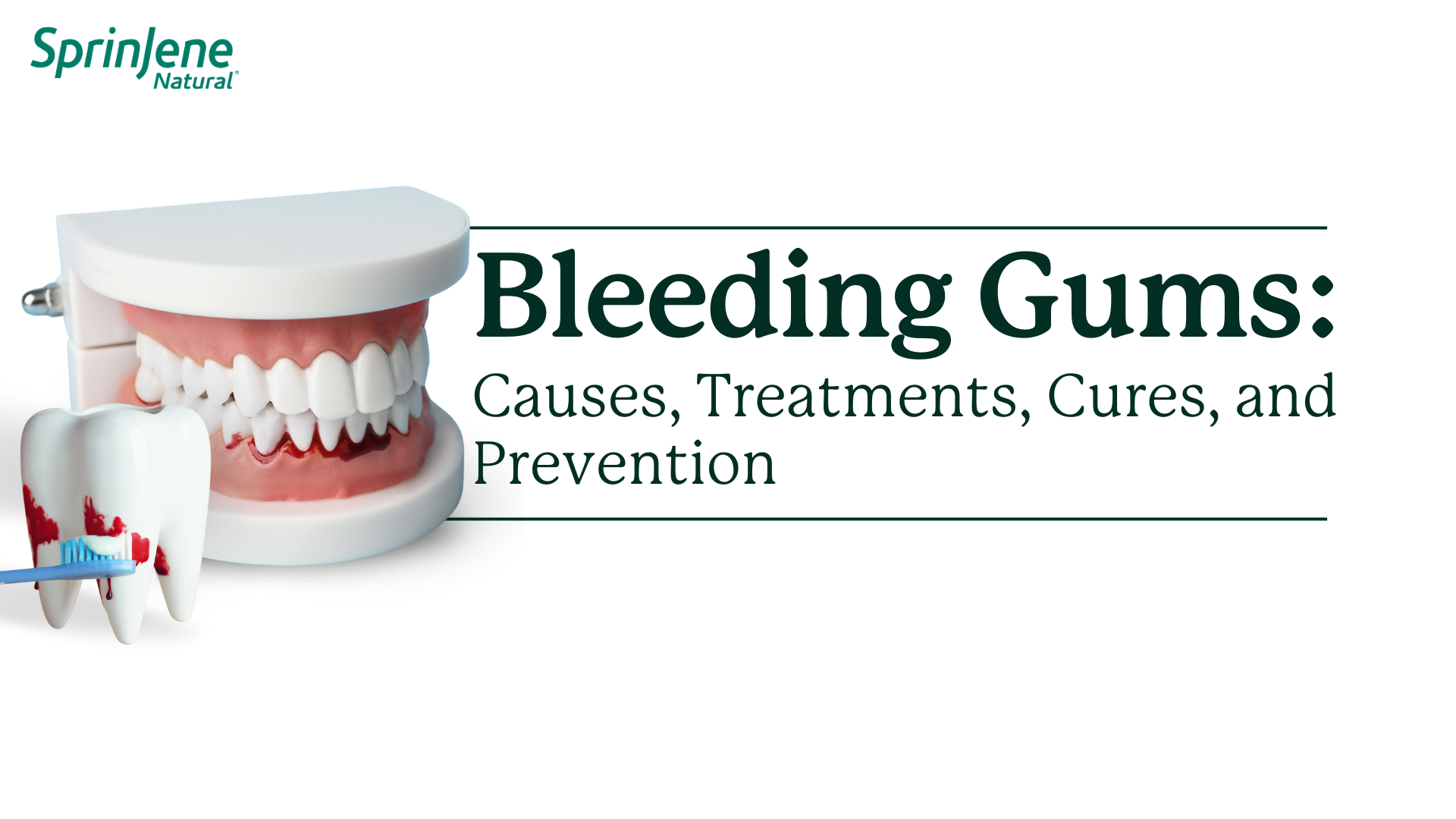 Bleeding Gums Causes Treatments Cures And Prevention Sprinjene 8776