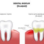 biofilm and teeth