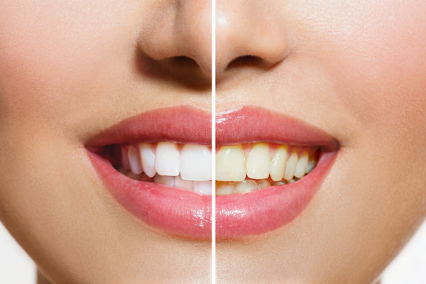 Whiten Your Teeth Naturally and Safely