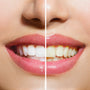 Whiten Your Teeth Naturally and Safely